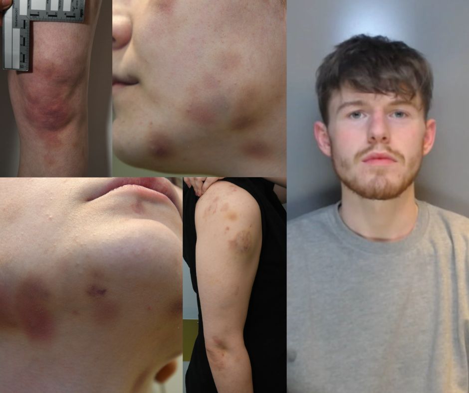 Jack Robson/Injuries to victim